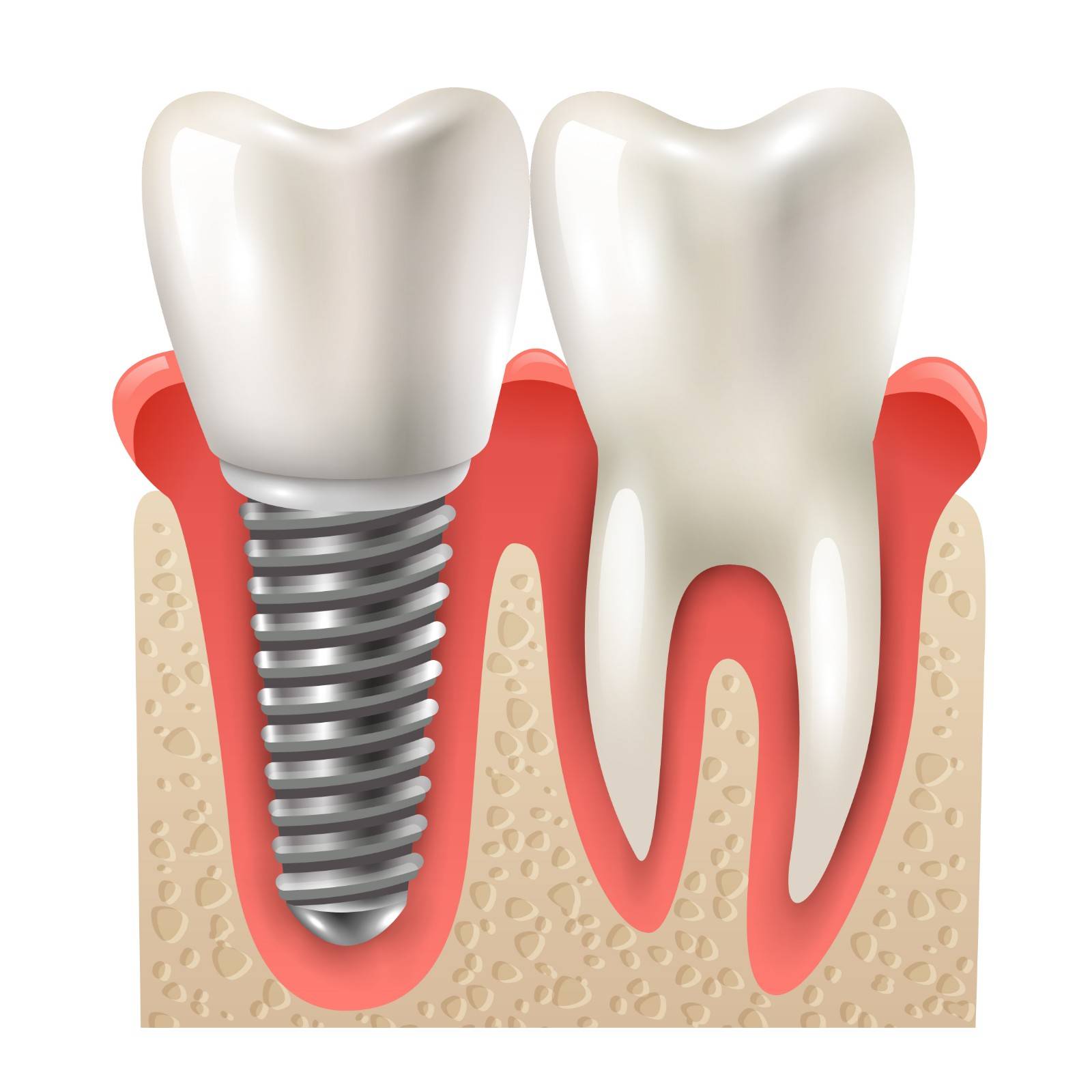 Best Dental Implant in Malviya Nagar