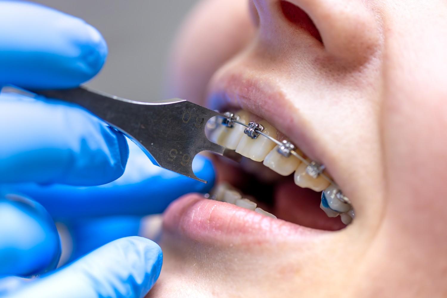Best Braces Treatment in Malviya Nagar