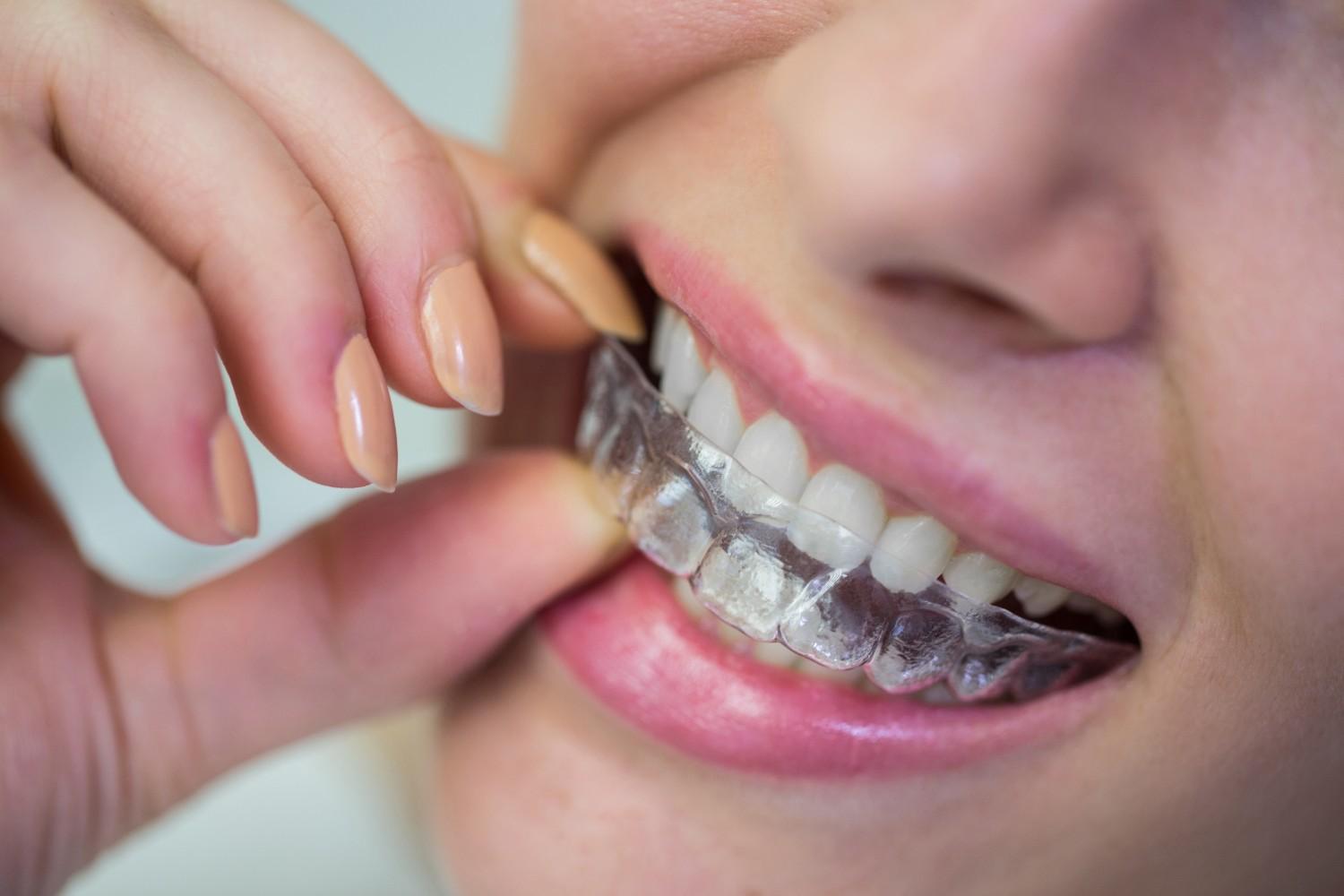 Dental Aligners Treatment in Malviya Nagar